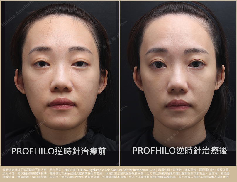 術前術後比一比 照片