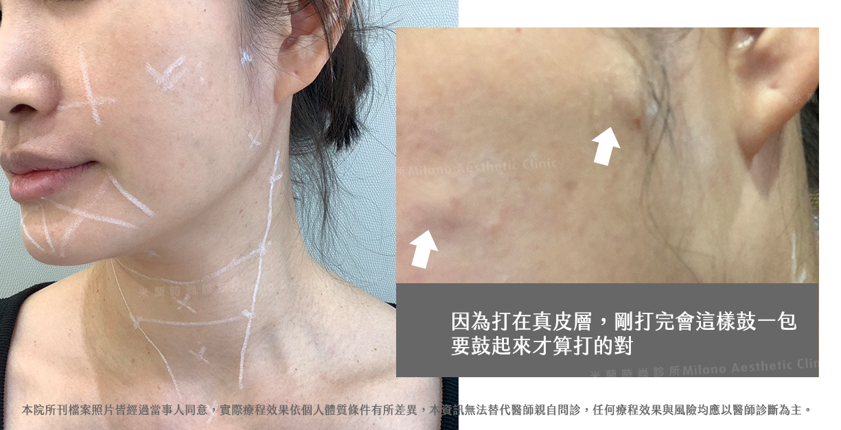 逆時針療程注射後的即時反應