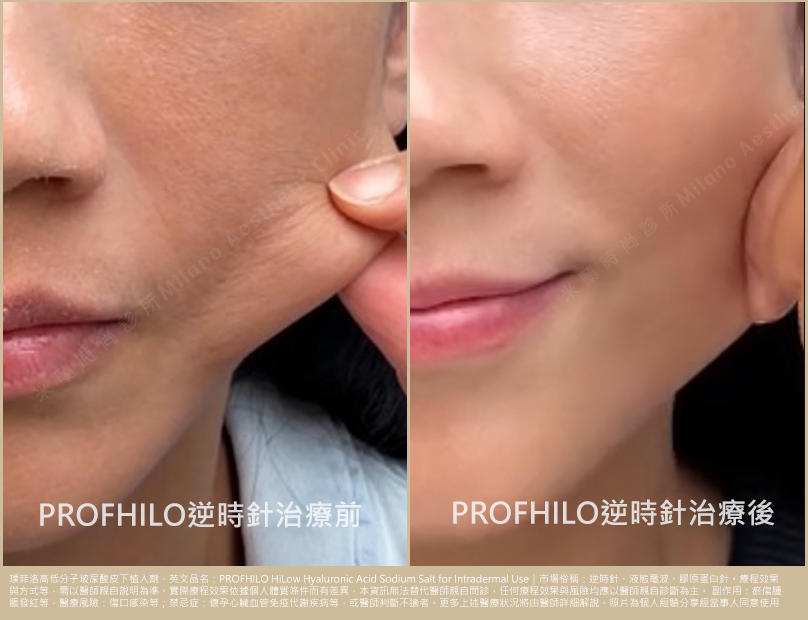 逆時針PROFHILO術前術後一個月比較圖