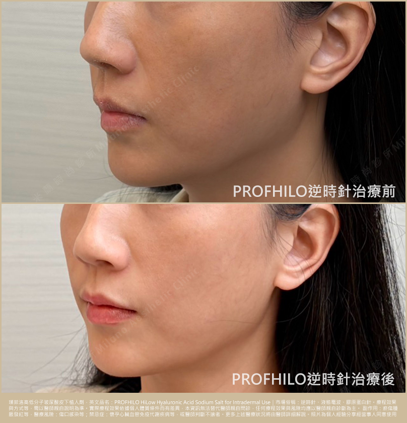 逆時針PROFHILO術前術後一個月比較圖