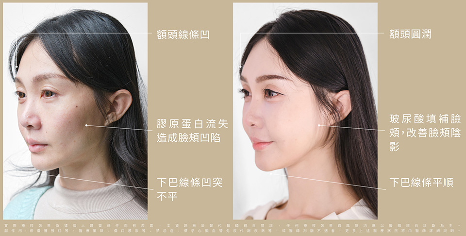 輕盈立體的骨相美術前術後比一比 照片