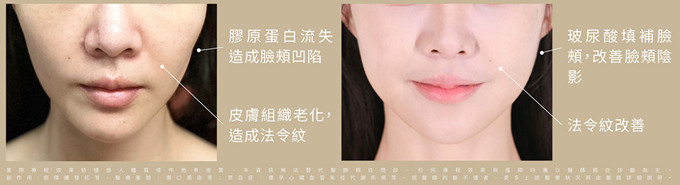 輕盈立體的骨相美術前術後比一比 照片