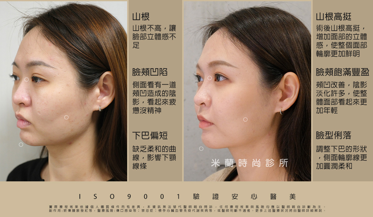 術前術後比一比 照片