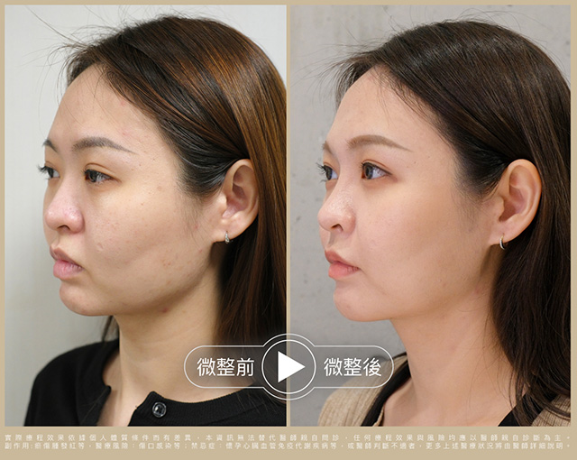 術前術後比一比 照片