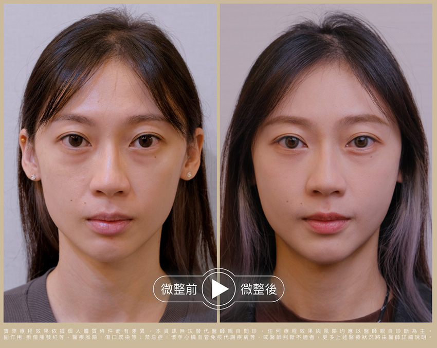 術前術後比一比 照片