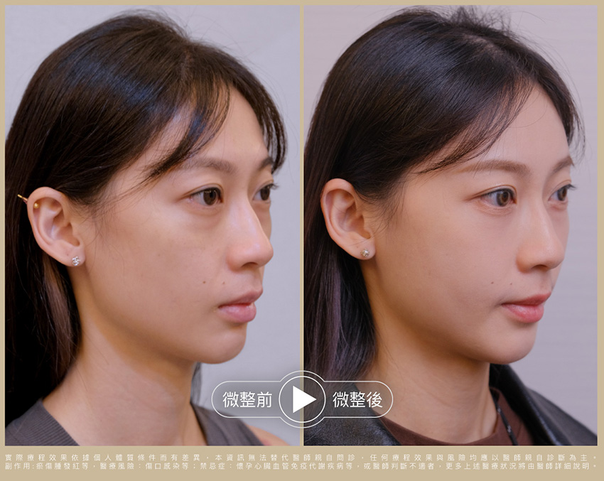 術前術後比一比 照片