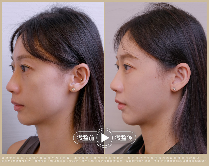 術前術後比一比 照片