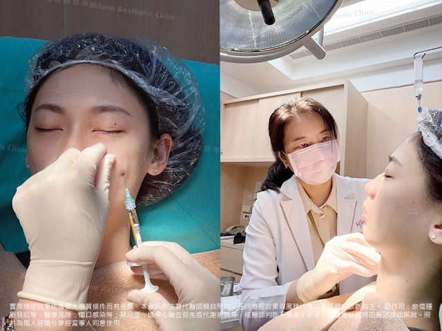 曾鈺涵醫師進行面部填充治療