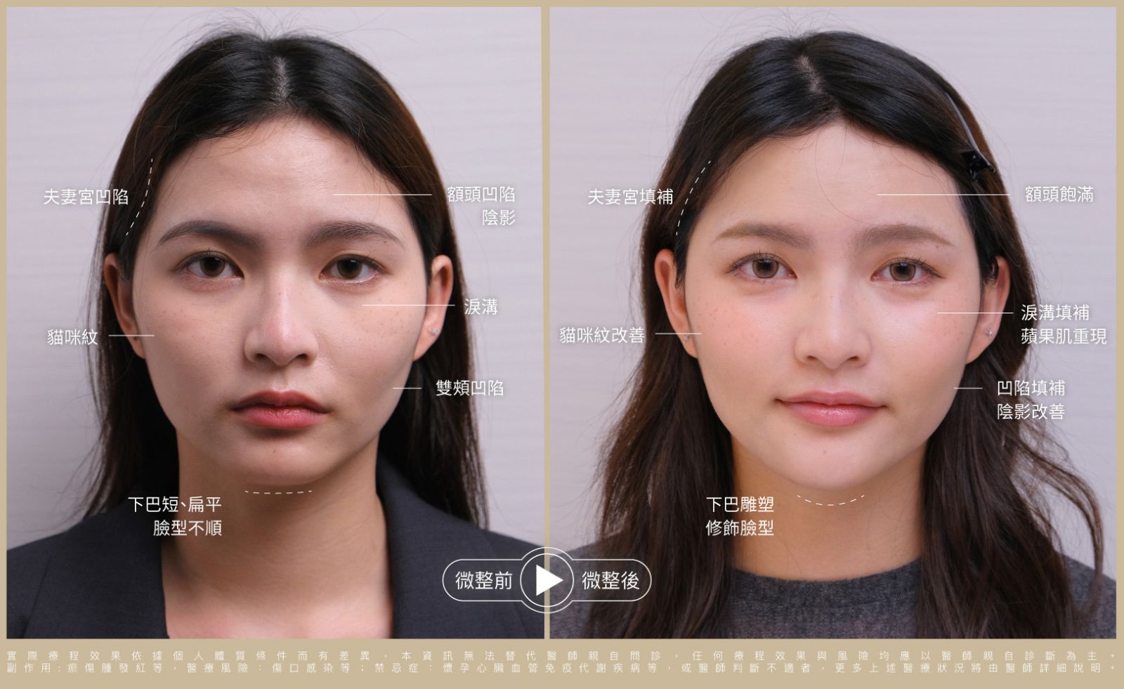 術前術後比一比 照片