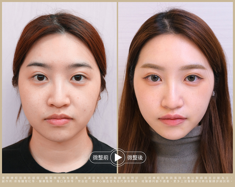 術前術後比一比 照片