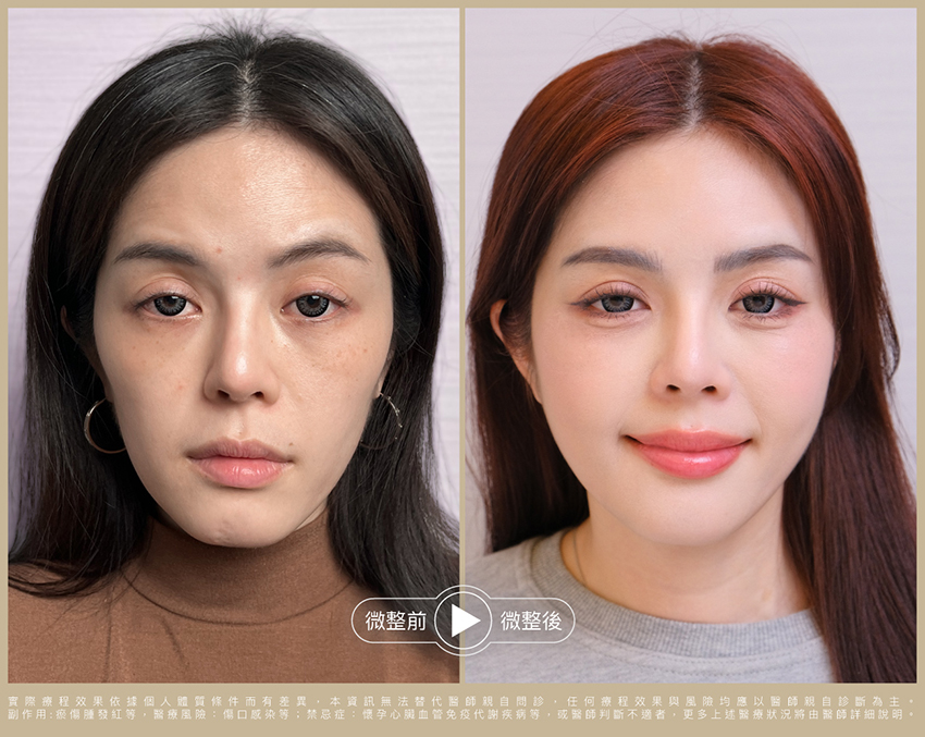 術前術後比一比