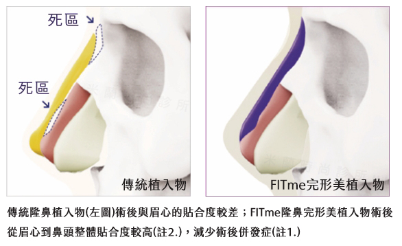 3D列印隆鼻