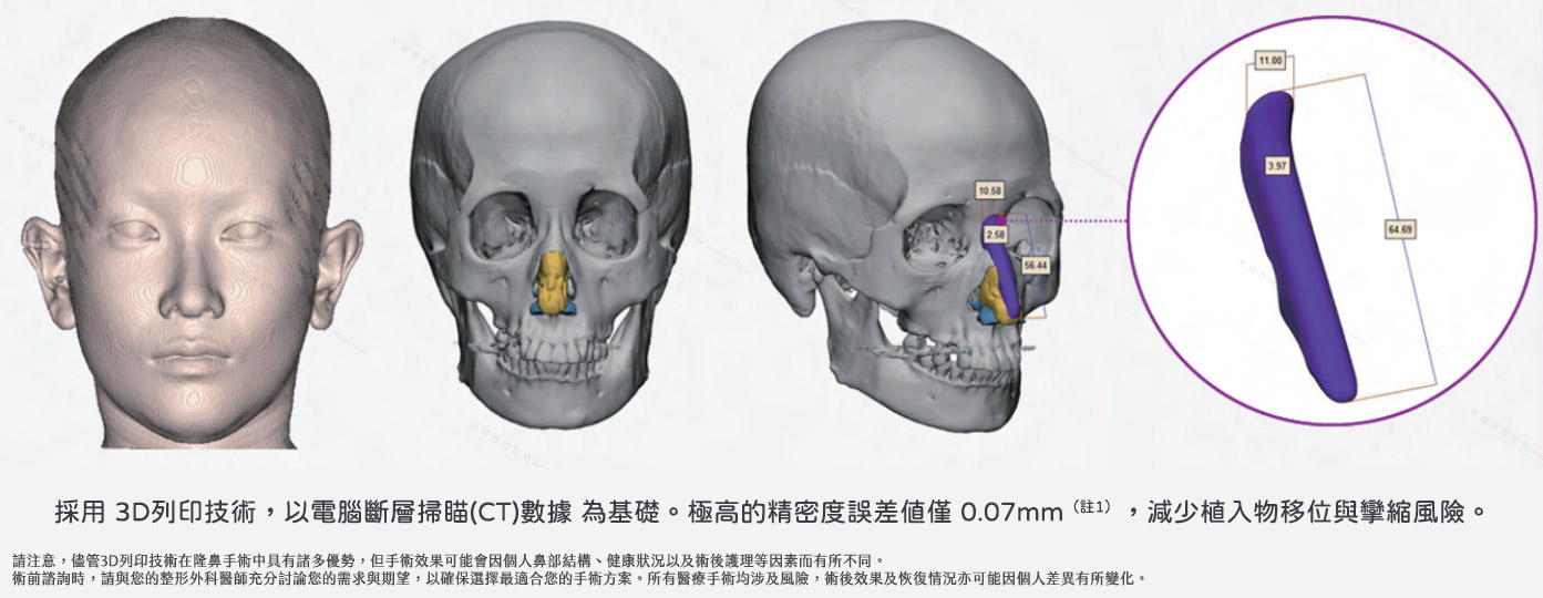 3D列印隆鼻