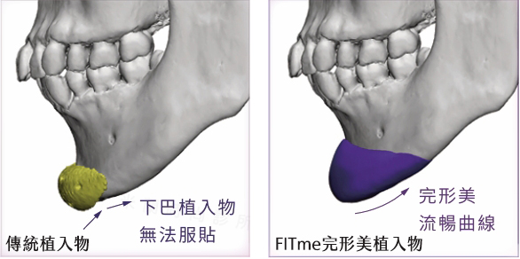 3D列印隆鼻