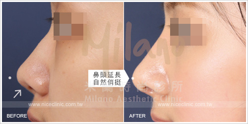 韓式隆鼻手術／矽膠鼻模 術前術後比較