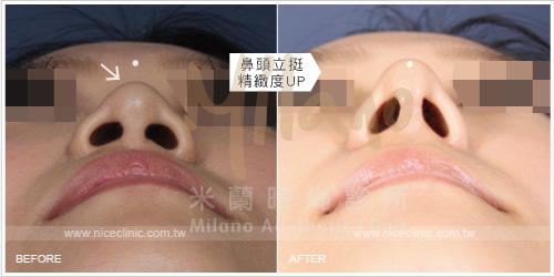 韓式隆鼻手術／矽膠鼻模 術前術後比較
