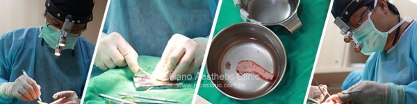 醫師於米蘭時尚診所進行自體3C隆鼻手術，專注雕刻鼻骨的畫面