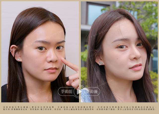隆鼻手術術後對比