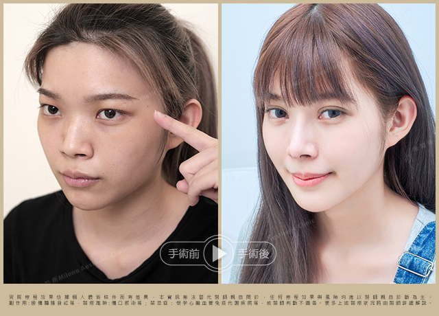 隆鼻手術術後對比