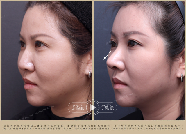 隆鼻手術術後對比