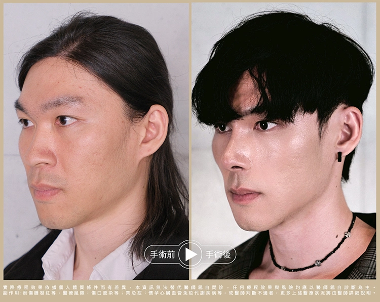 男性結構式美學隆鼻前後左側臉斜面圖：鼻樑與鼻尖的自然銜接，氣質從柔和轉為韓系。