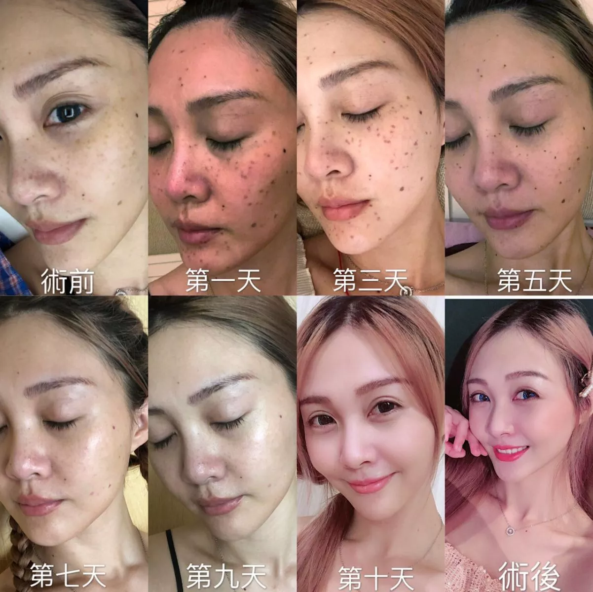 皮秒雷射除斑10日術前術後臨床實例