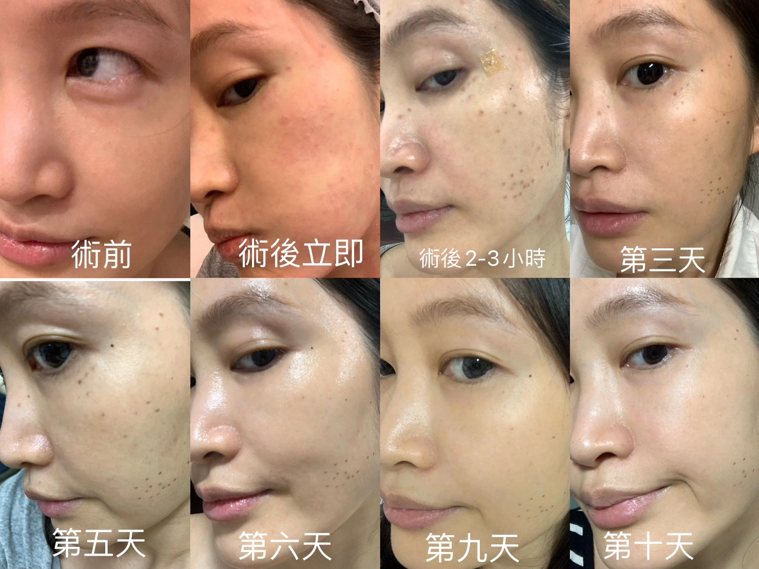 皮秒雷射除斑10日術前術後臨床實例