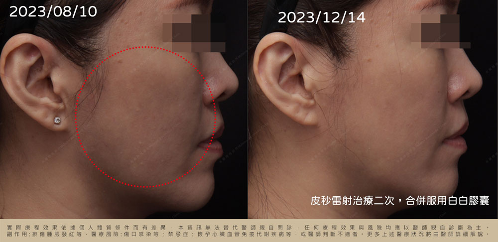 皮秒雷射治療二次術後４個月記錄
