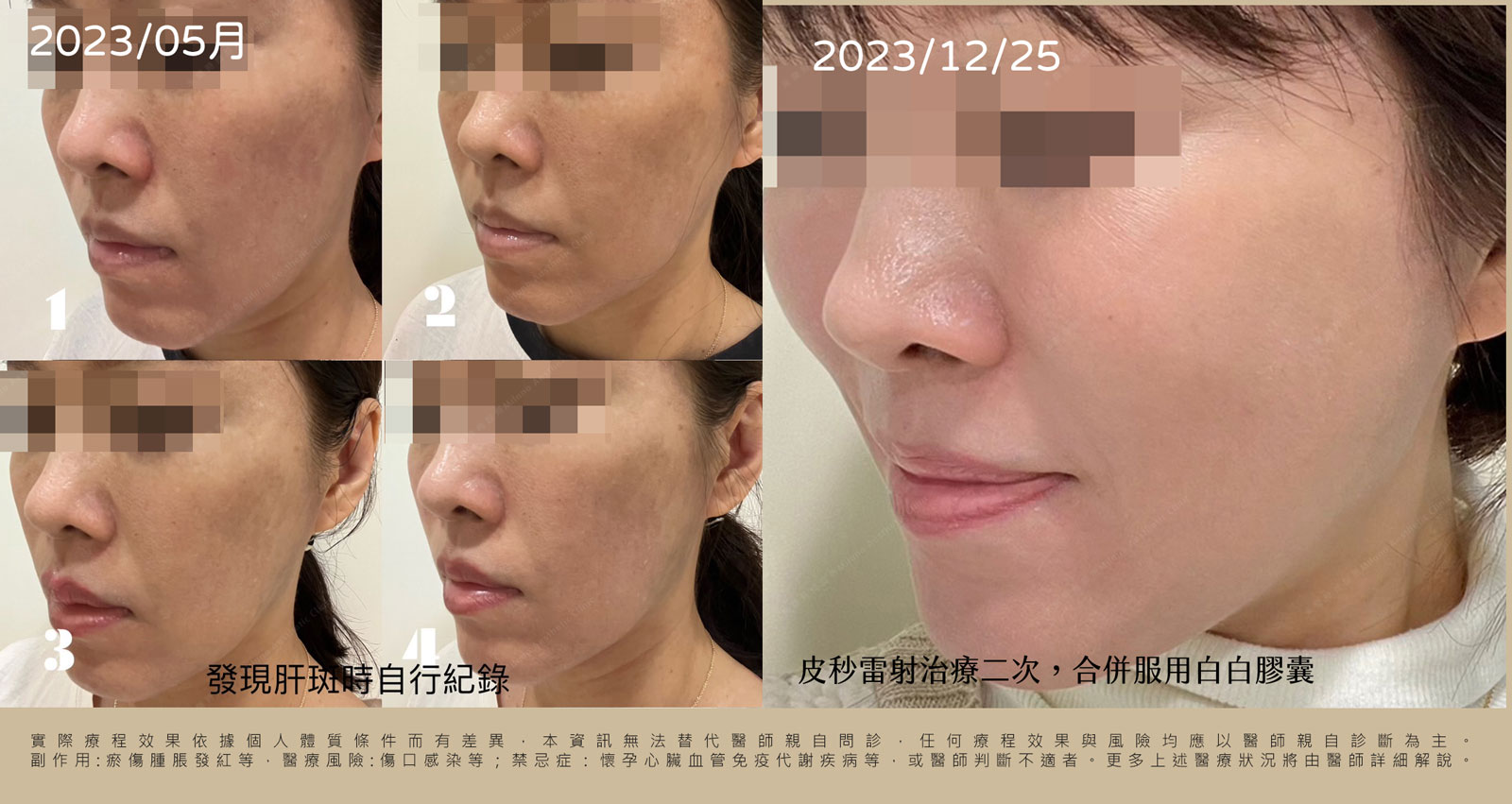皮秒雷射術後四個月真實記錄