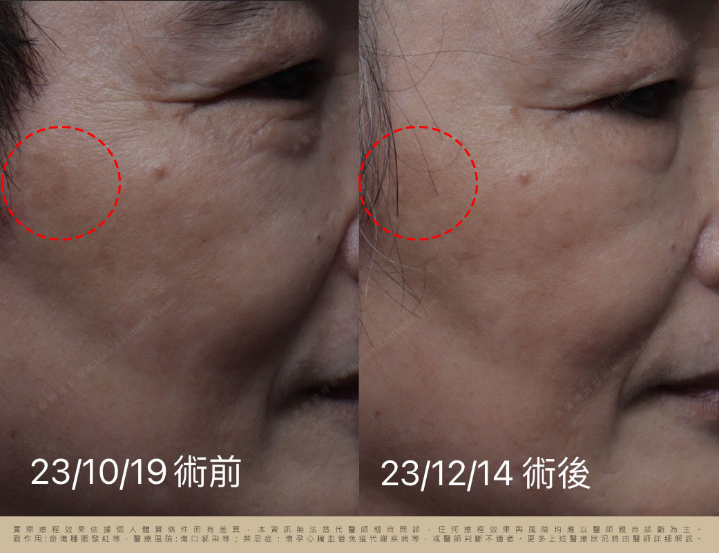 皮秒雷射一次治療後二個月，肝斑淡化紀錄