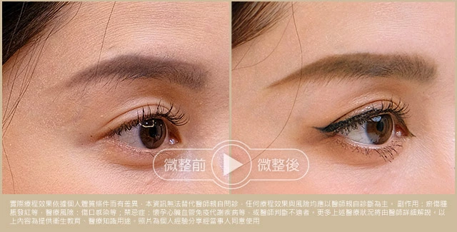 無限電波+麗珠蘭組合術前術後比較圖