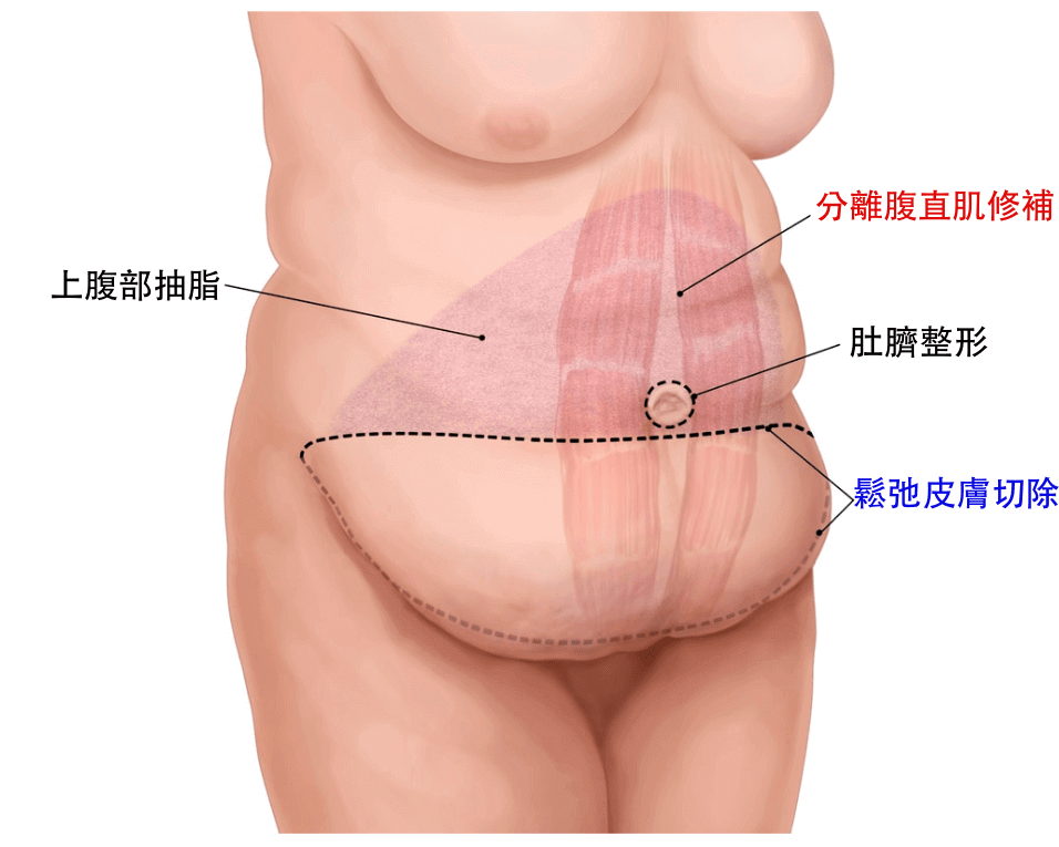 腹部拉皮手術動機
