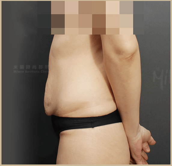 腹部整形手術去除小腹馬甲強化腰線術前小腹