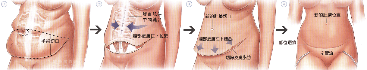 腹部整形手術修補腹直肌筋膜示意圖