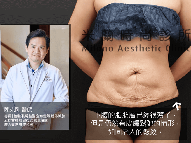 陳克剛醫師提供的腹部拉皮案例