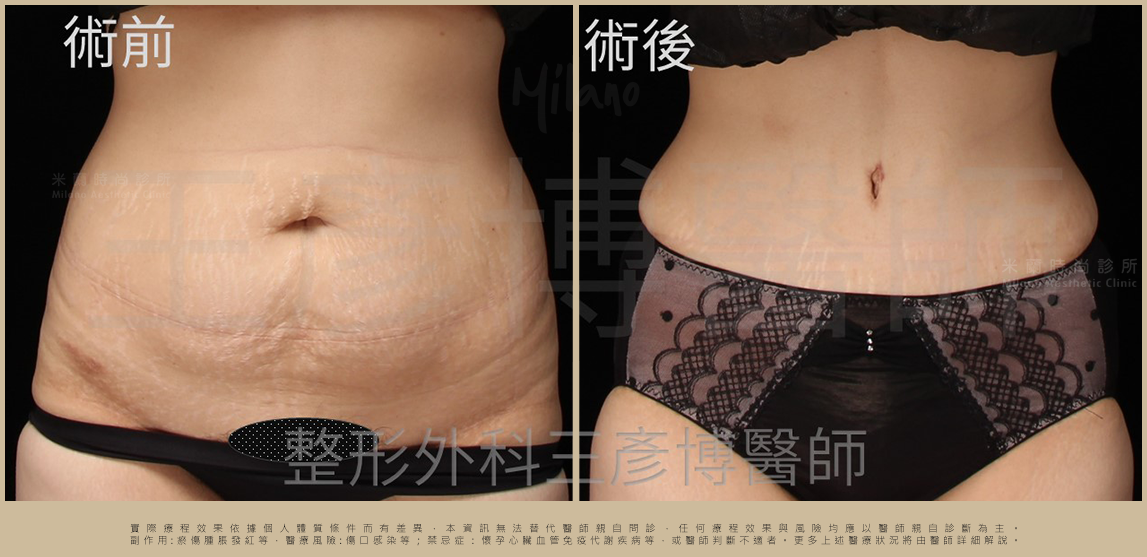 腹部整形
