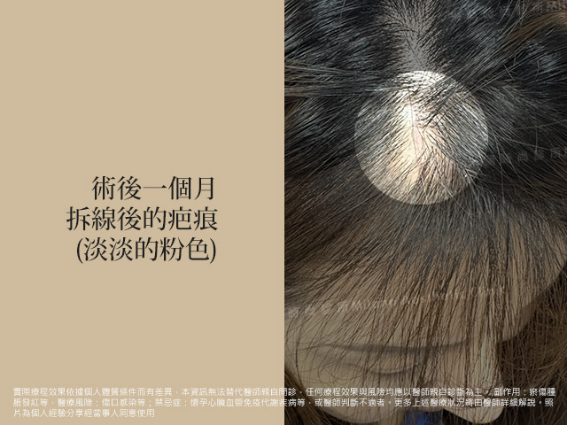 拆線後的疤痕