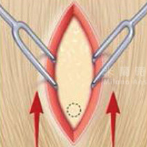 進行切口，確認鑽孔位