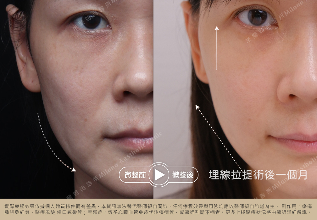 職業婦女Alice術後