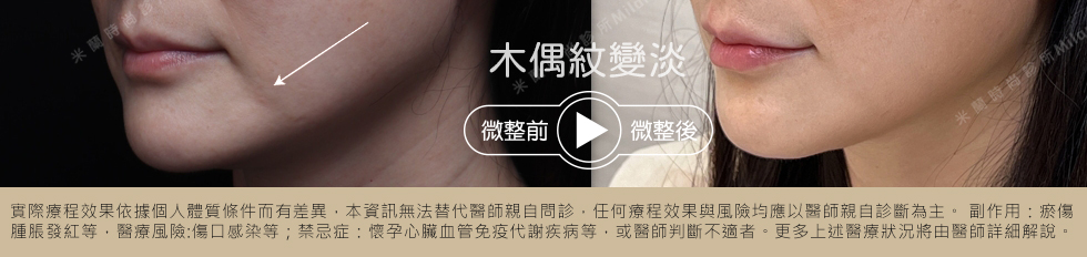 埋線拉提搭配玻尿酸