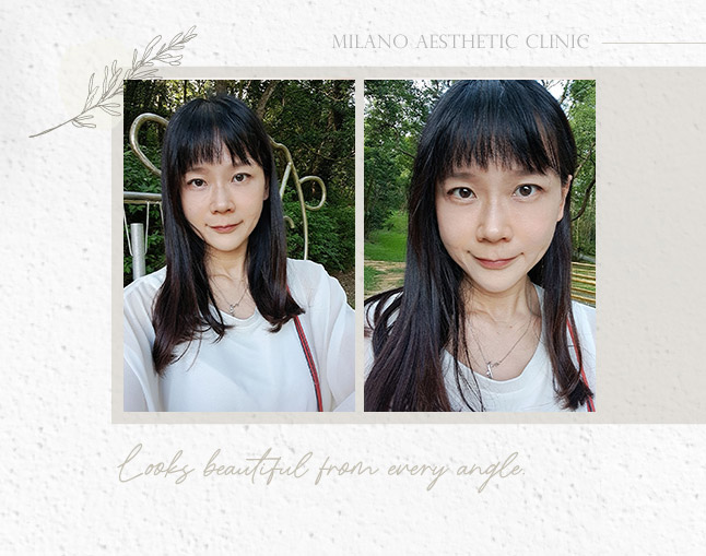職業婦女Alice術後