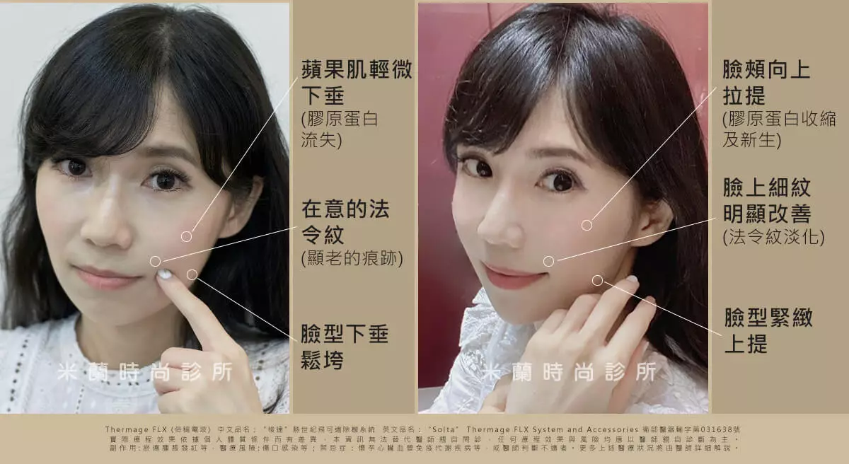 鳳凰電波術前術後拍攝比較