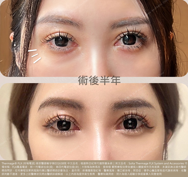 眼周電波的術前術後比較