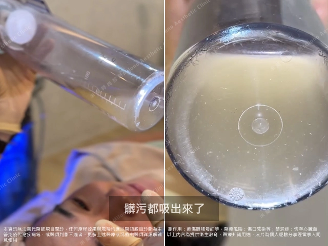 執行海菲秀過程