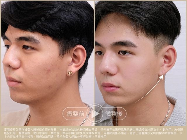 本案例男士醫美療程前後對比圖