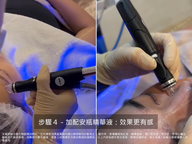 執行海菲秀過程
